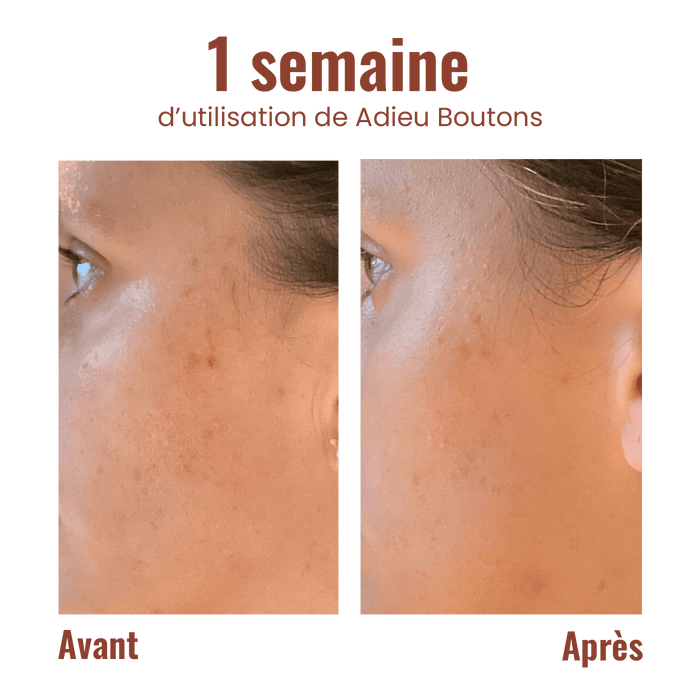 Adiós granos - Aplicador rodante anti-imperfecciones