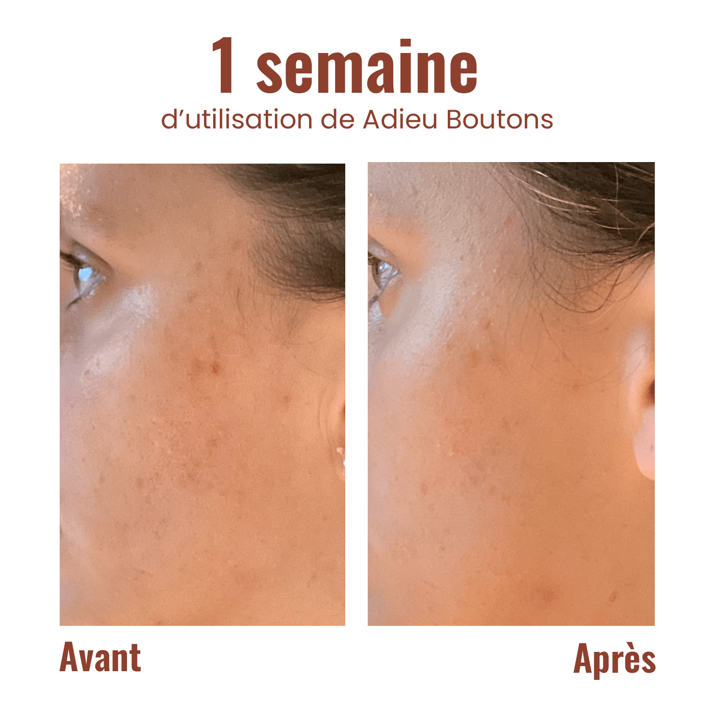 Adiós granos - Aplicador rodante anti-imperfecciones