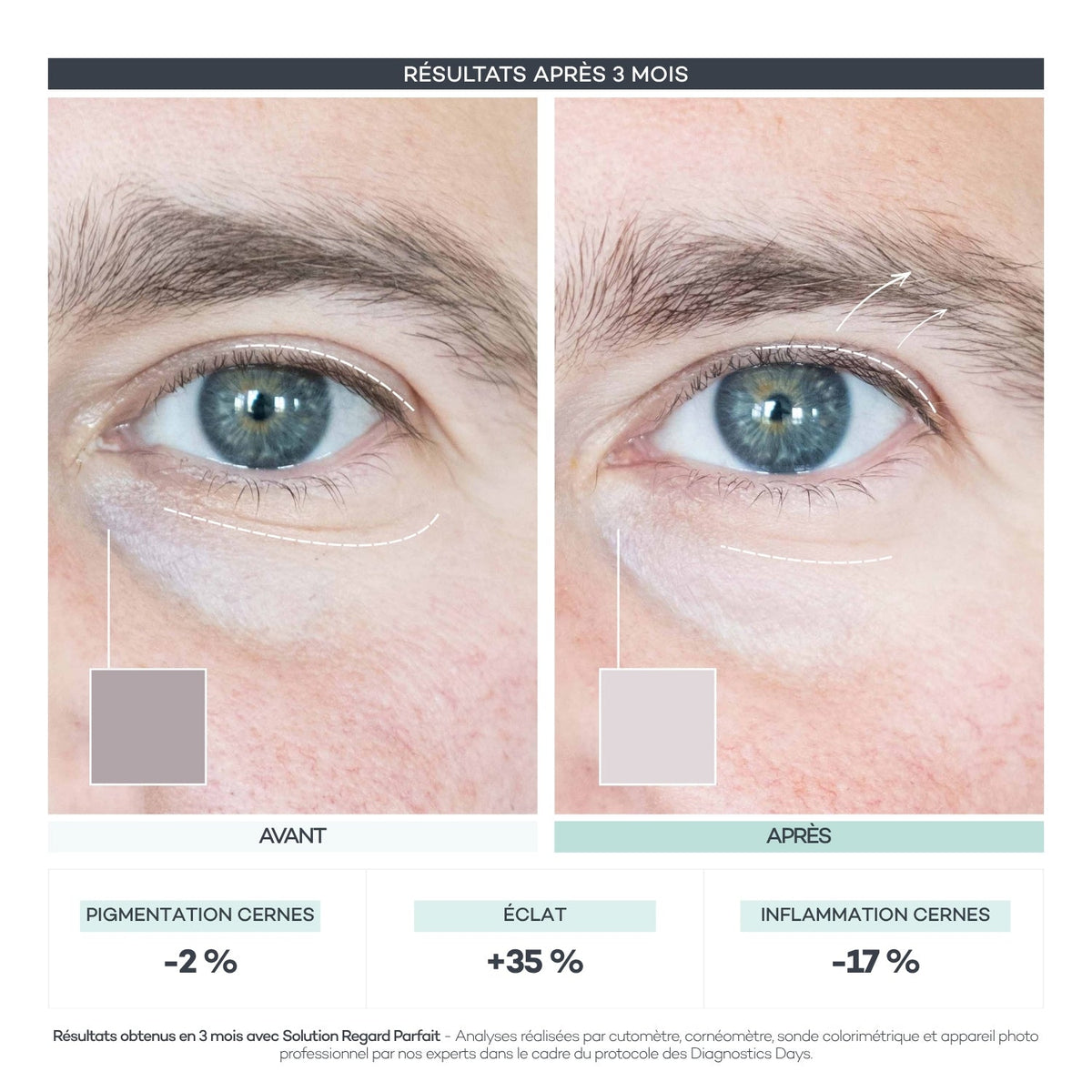 Avant après 3 mois du Shot Regard Parfait : +35% d'éclat, -17% d'inflammation des cernes