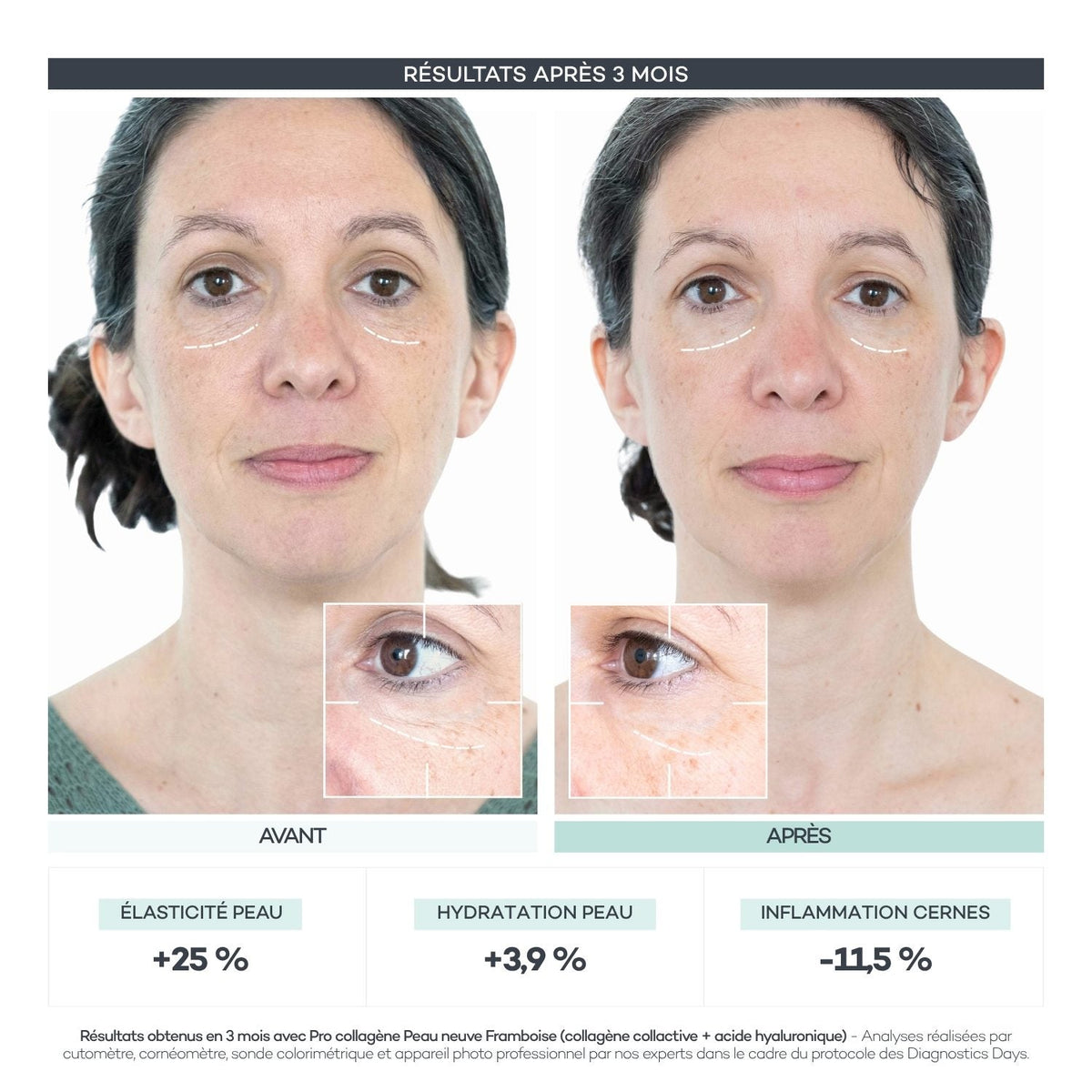 Avant après 3 mois de Routine Découverte Peau D-LAB en sticks : +25% d'élasticité, +3,9% d'hydratation, -11,5% d'inflammation des cernes