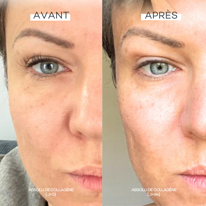 Disparos Absolutos de Colágeno